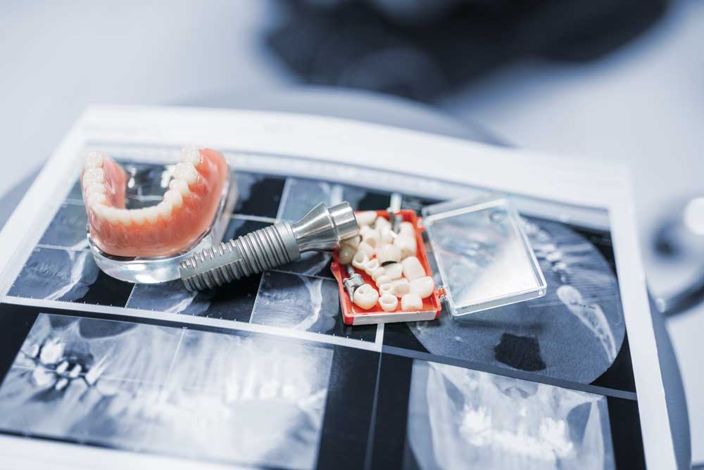 herausnehmbarer-zahnersatz-gebiss-auf-roentgenbild-auf-schreibtisch-berlin-02a