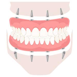 zahnersatz-vektorgrafik-schema